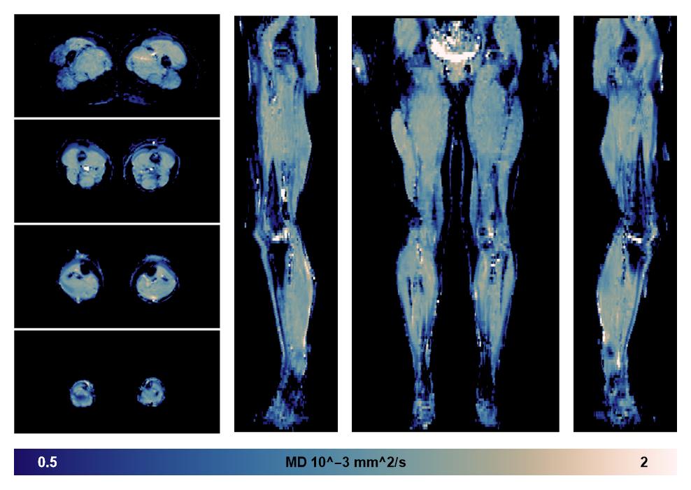 IVIM corrected whole leg muscle mean diffusivity obtained from diffusion tensor imaging.